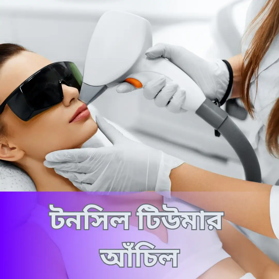 টনসিল টিউমার আঁচিল